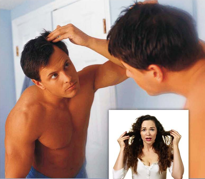 Alopecia o Calvicie
